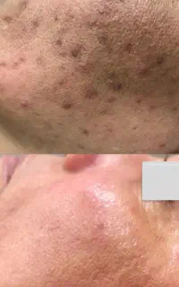 پاکسازی ۱۲ مرحله و درماپلینگ فقط امروز ۳۵۰ تومان