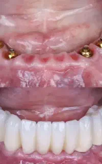 شرایط اقساطی دندان پزشکی و ایمپلنت