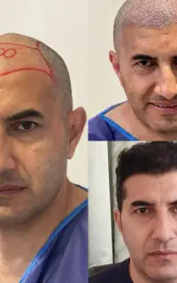 کلینیک کاشت مو و ابرو