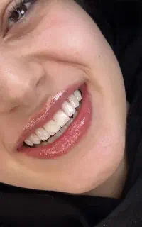 لمینیت/کامپوزیت/ایمپلنت بااقساط ویژه