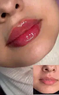 تزریق فیلر ودرمان پوست و مو