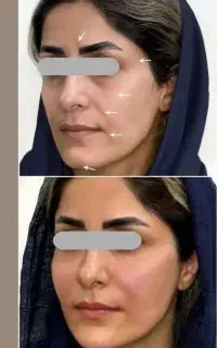 بلفارو پلاستی و انواع فیلر لب بینی چشم ساکشن غبغب