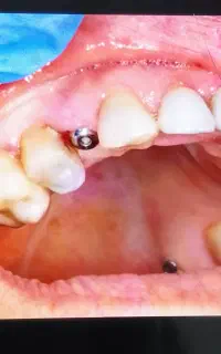 مرکزفوق تخصصی ایمپلنت دیجیتال/فوری/سبک کاخ لبخند