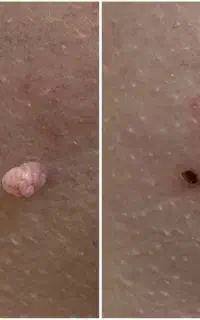 رفع زگیل و منگوله گوشتی