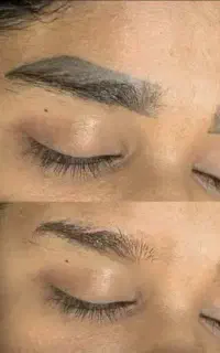 ریموو تاتو پاک کردن تتو