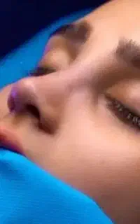 عمل جراحی زیبایی بینی اهواز