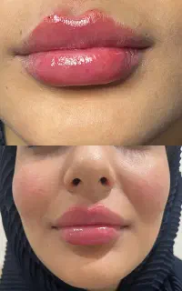 ژل و بوتاکس