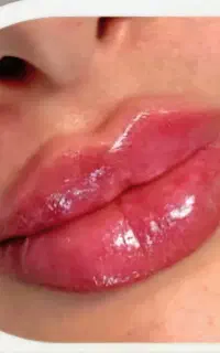 آموزش و خدمات ژل لب،فیلر ،بوتاکس، مزوژل
