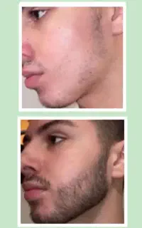 بمب رویش مجدد