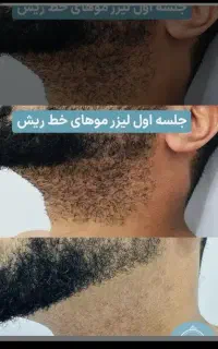لیزر رایگان/آقا/خانم/باقویترین دستگالیزرموزائد۲۰۲۶