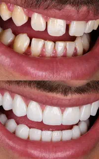 کامپوزیت شروع از فکی ۱۰ تومان با ضمانت