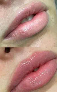 آموزش کامل تزریقات ژل و بوتاکس و آنزیم ۷۰۰۰/۰۰۰