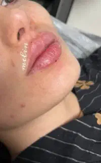 ژل بوتاکس با بهترین متریال فقط ۸۹۹تومان تضمینی