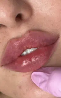 لیزر شاتی نابلکس کره و ژل و بوتاکس