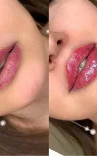 آفر پاییزی فیلر و بوتاکس ،مزوژل جوانسازباقیمت ویژه