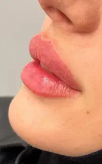 فیلر ژل بوتاکس