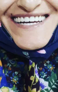 ساخت دندان مصنوعی بیرانوند