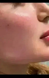 جشنواره یک روزه ژل و بوتاکس