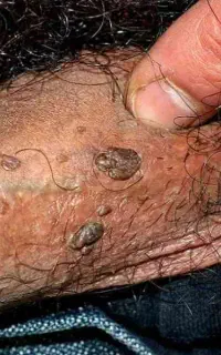 رفع سریع منقوله های زگیل ریشه ای