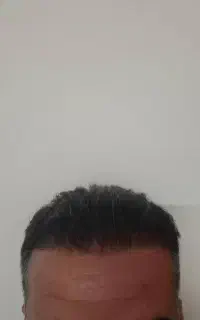 کلینیک تخصصی کاشت مو و ابرو ایرانیان