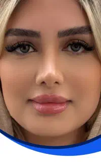جراحی بینی با قیمت استثنایی