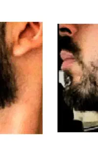 پرپشت کننده ریش و رویش مجدد