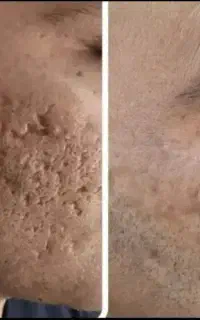 درمان تخصصی جای جوش اسکار‌ سوختگی‌ بخیه
