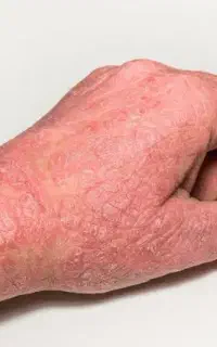 با یک دمنوش درمانش کن