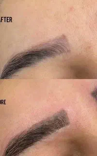 ریموو تاتو/فیبروز/انواع آرایش دائم چشم و لب و ابرو