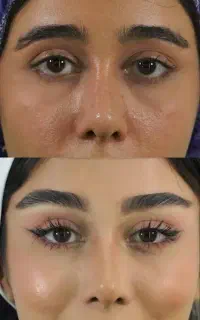 مرکز بلفاروپلاستی لیزری دیجیتالی مشهد/شقیقه/غبغب