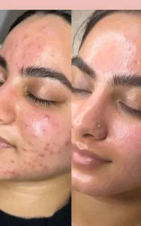 پاکسازی صورت فقط فقط ۴۰۰تومان