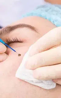 کوچیک کردن بینی گوشتی