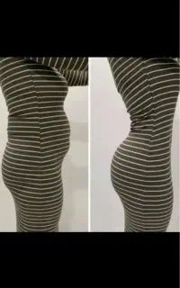 لیپوماتیک بدون بیهوشی بدون جراحی بدون درد