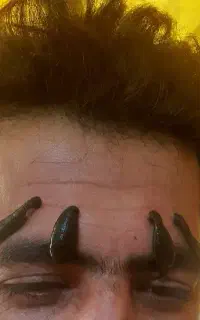 زالودرمانی،حجامت و بادکش، دیسک و سیاتیک