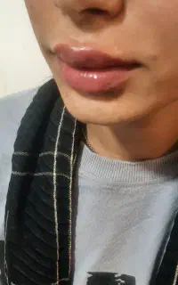 تزریق ژل کره ای با ماندگاری بالا
