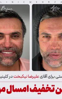 بلفاروپلاستی /زیبایی با تخفیف ویژه