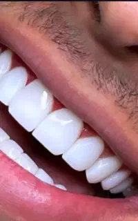 کامپوزیت هر فک فقط ۱۴۰۰۰ تومن اقساطی رشت و تهران