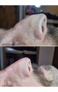 اصلاح تخصصی فرم بینی وبهبود تنفس
