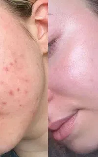 درمان ریشه‌ای منافذ پوست چین‌چروک لک و جوش
