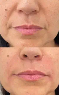 مدل تزریق ژل و  بوتاکس