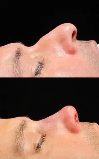 جراحی رینوپلاستی-شاهرود