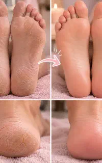 اف ویژه پدیکور تخصصی و حرفه‌ای پا