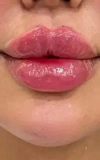 تزریق ژل لب ،فیلر بوتاکس ،پیرسینگ گوش بینی ناف