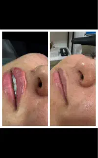 بوتاکس لیزر ژل چربی لابیاپلاستی مطب