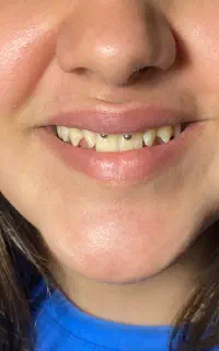پیرسینگ بدون درد و خونریزی