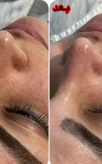 فیشیال پوست با دستگاه آف فقط تا ۳ روز