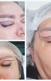 عمل افتادگی پلک