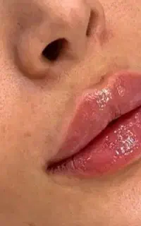 آموزش مجازی  فیلر وآموزش حضوری ژل