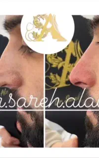 اصلاح فرم بینی بدون جراحی توسط پزشک