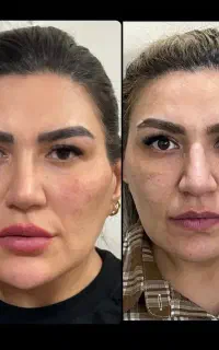 جشنواره فیلرلب زوایه فک وبوتاکس،لیفت با نخ،مزووایت